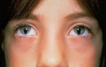 Причины рождения людей с синдромом кошачьего глаза и их особенности