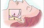 Что такое синдром обструктивного апноэ и как его вылечить