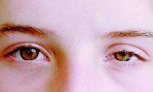От чего возникает синдром верхней глазничной щели и какие осложнения он может принести