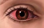 Причины возникновения синдрома красного глаза и как его лечить