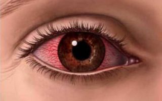 Причины возникновения синдрома красного глаза и как его лечить
