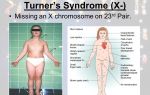 Симптомы синдрома Мея Тернера и как его лечат