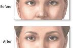 Способы лечения синдрома ленивого глаза и провоцирующие факторы