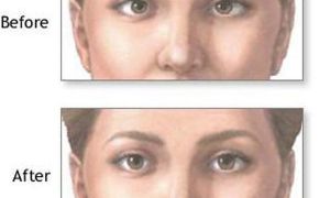 Способы лечения синдрома ленивого глаза и провоцирующие факторы